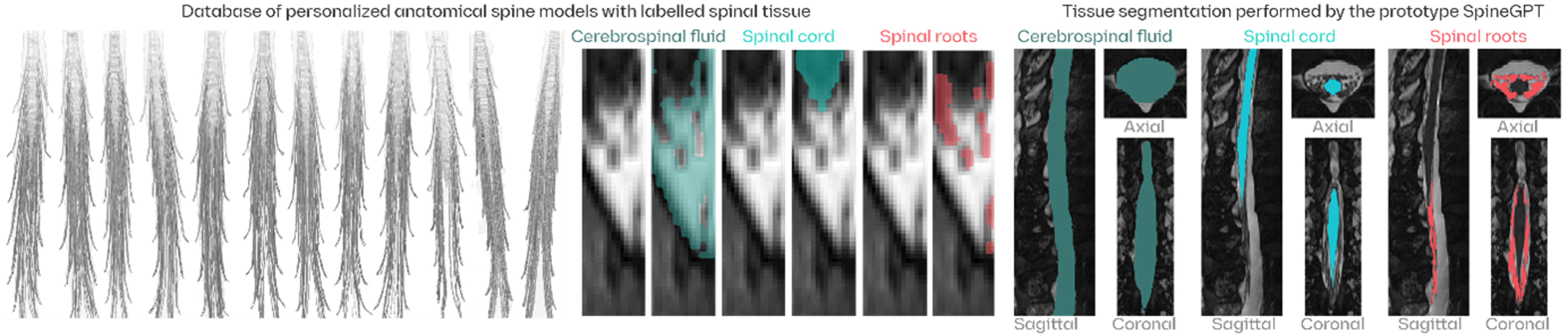 Figure 2 — SpineGPT pipeline and preliminary segmentation results